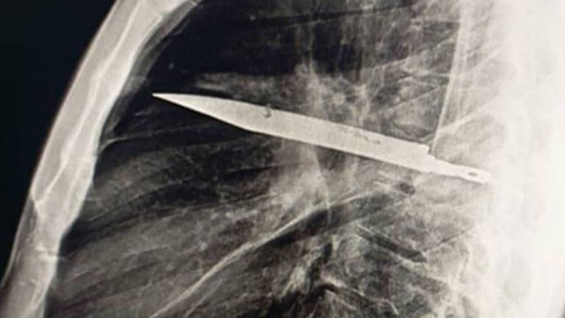 S nožem v plicích žil osm let. Pacient z Tanzanie šokoval lékaře, zbraň odhalil až rentgen