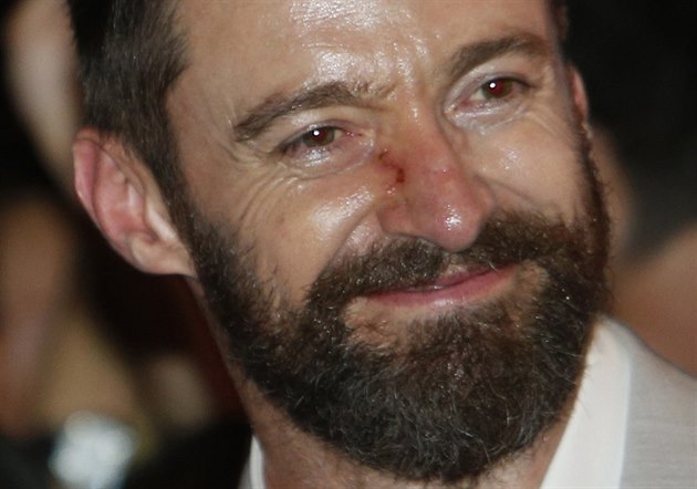 Černochová bojovala s bazaliomem. Totéž řešil i Jackman nebo Ramsay