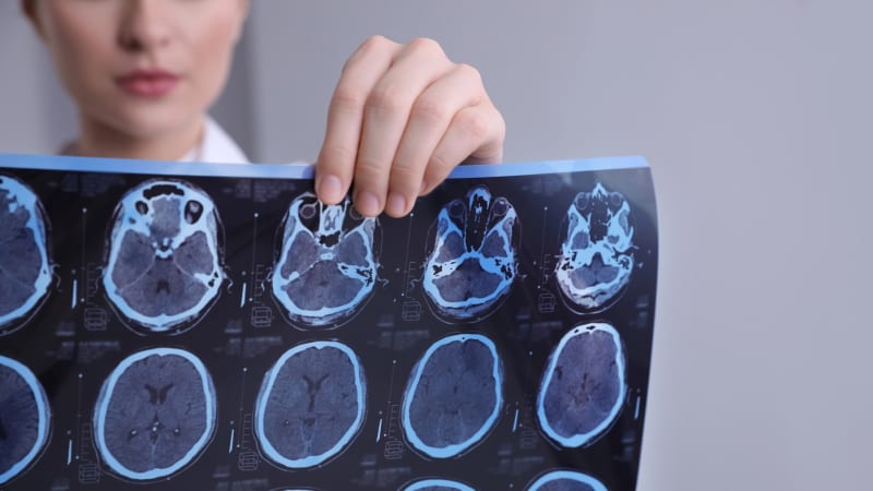 Poznají roztroušenou sklerózu z pouhé řeči. Čeští vědci pracují na revoluční technologii
