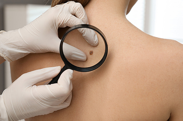Naděje pro pacienty s melanomem. Nová data potvrdila účinnost mRNA vakcíny